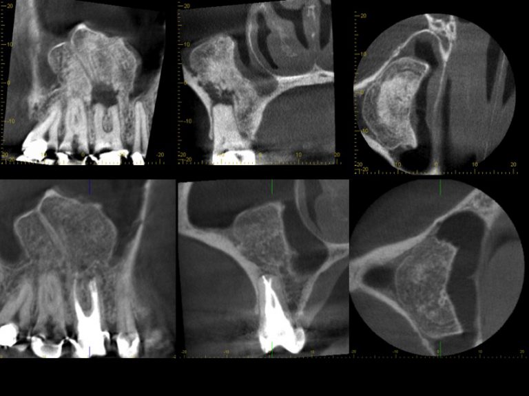 Ossifizierte Zyste - Praxis für Endodontie und Zahnerhaltung - Zahnarzt